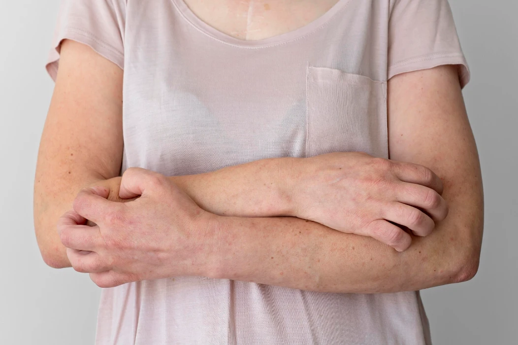 Skin allergy reaction on person's arm